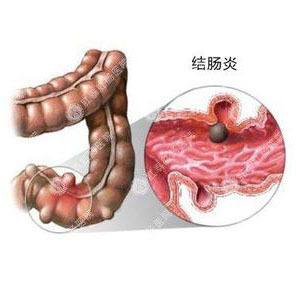 溃疡性结肠炎