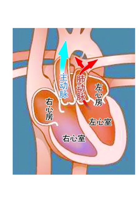 完全性大动脉转位