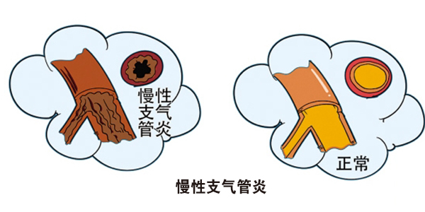 慢性支气管炎