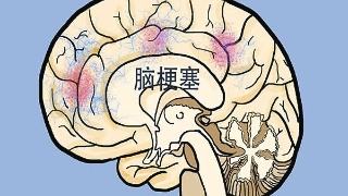 脑梗塞
