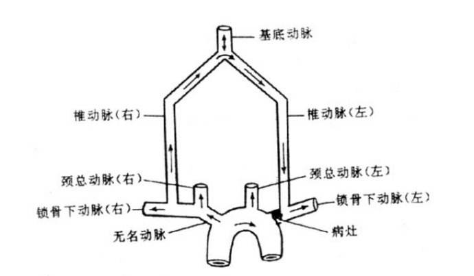 椎-基底动脉盗血综合征