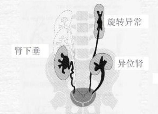 肾下垂