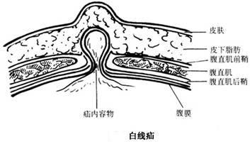 白线疝