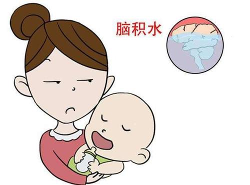 脑积水