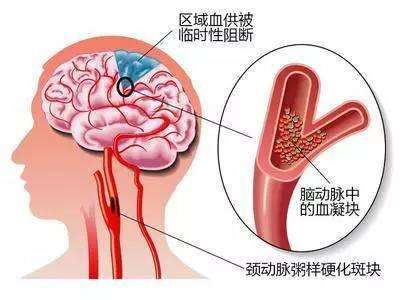 脑动脉硬化
