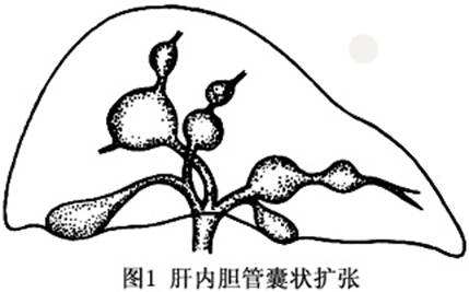 先天性胆管扩张症