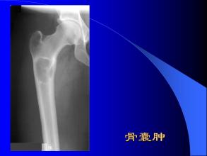 骨囊肿