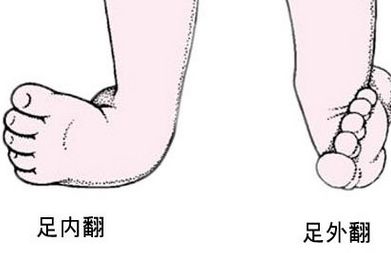 足外翻