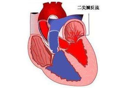 二尖瓣关闭不全