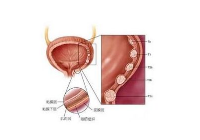 膀胱肿瘤