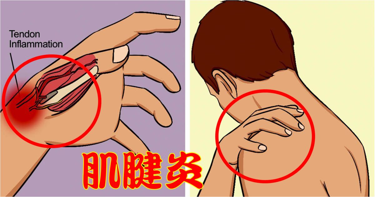 肌腱炎