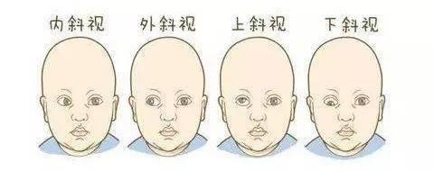 麻痹性斜视