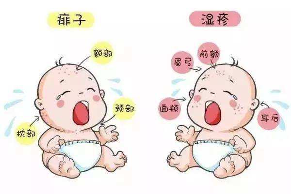 小儿湿疹