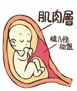 胎盘植入
