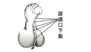 小儿尿道下裂