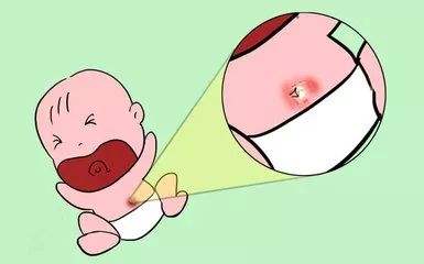 新生儿脐炎