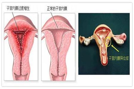 子宫内膜增生