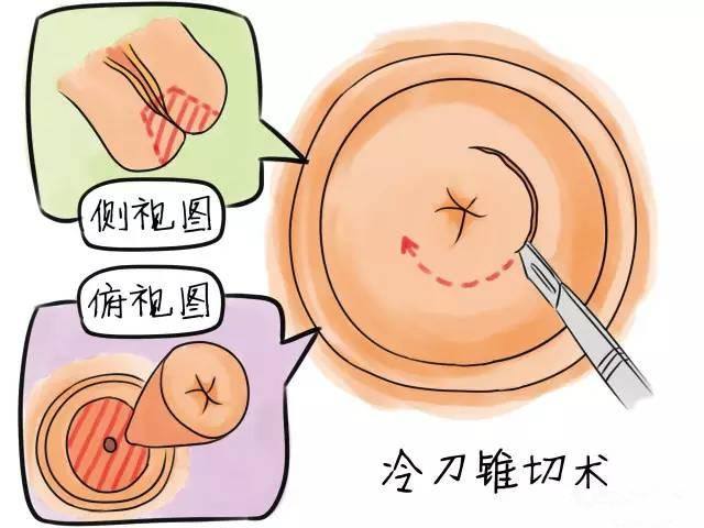 宫颈锥切术