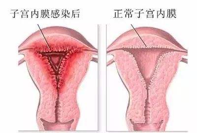 子宫内膜息肉