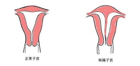 子宫纵膈