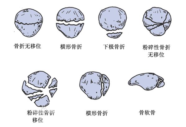 髌骨骨折