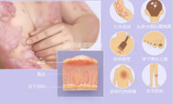 牛皮癣