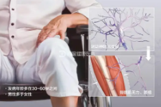 肌萎缩侧索硬化